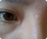 사라졌으면 좋겠어요, 나의 수두흉터!_1